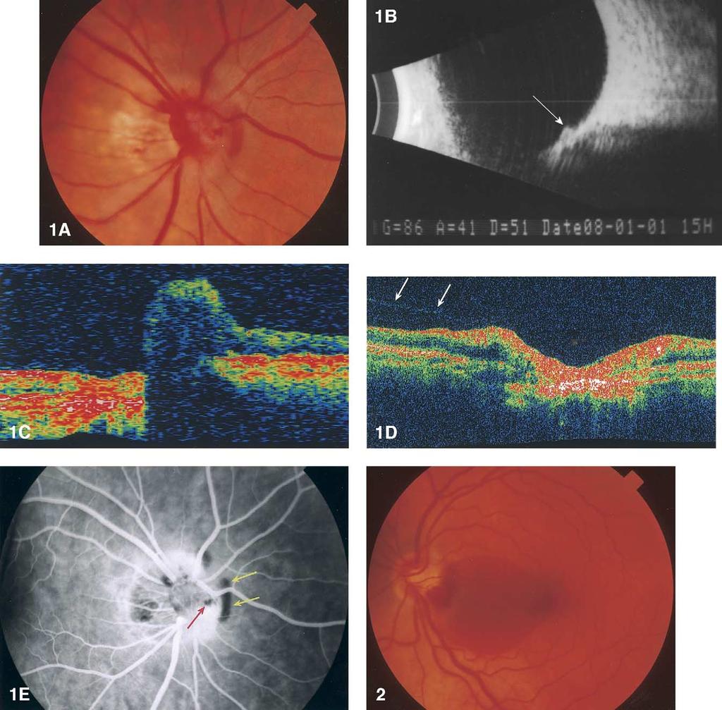 Ophthalmology Volume 111, Number 5, May 2004 Figure 1.