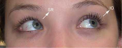 The extraocular muscles do not act in isolation.