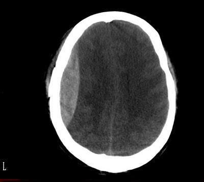 CT-Brain Epidural Hemorrhage