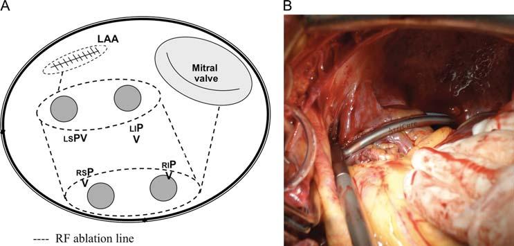 38 A. Bogachev-Prokophiev et al. / Interactive CardioVascular and Thoracic Surgery bipolar ablation described by Benussi et al. [4]. The left atrial appendage was excluded in all cases.