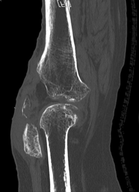 433 Simultaneous Bilateral Patellar Tendon Ruptures Associated with Osteogenesis Imperfecta condition before