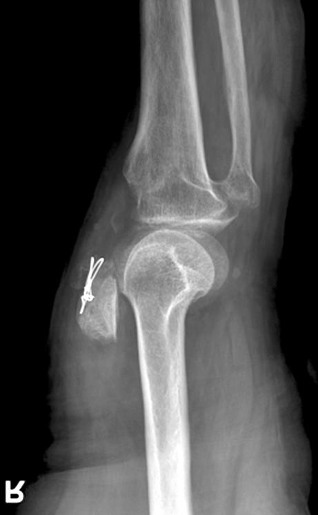 In addition, she had open reduction past for multiple fractures (Fig.