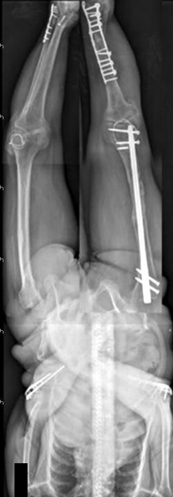 434 Woong Hee Kim, et al. Figure 5. The patient had been admitted to the hospital 13 times in the past for multiple fractures.