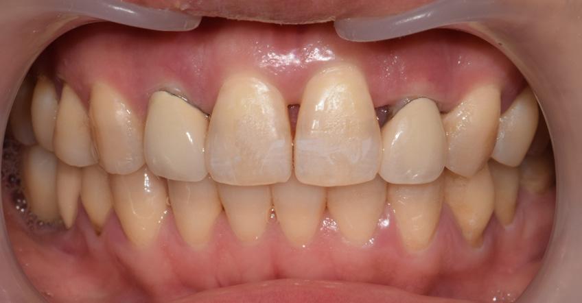 Once gap was closed, a single visit restoration would be used to replace the old PFM crowns. 3Shape TRIOS Design Studio was used to create the crowns with an Amann Girrbach Ceramill motion 2 mill.