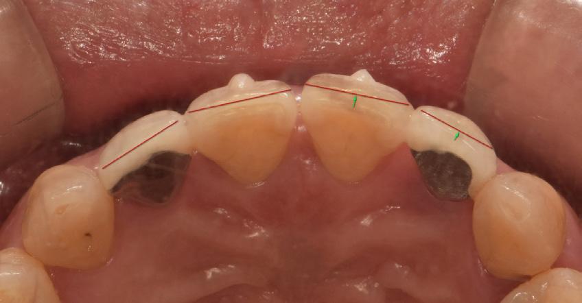 The recovery of the ideal arch form for upper anterior teeth and an improved crown margin with abutment teeth (#12, #22) with the replacement of the old PFM crowns to E.max crowns. Fig. 2.