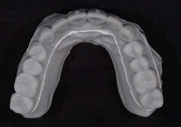 3D Printed digital set up model Aligner was made with Scheu s Ministar and 0.20mm clear sheet.