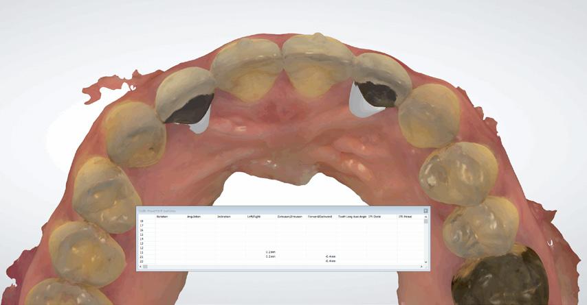 After one week of aligner treatment, the anterior teeth were positioned within normal arch.