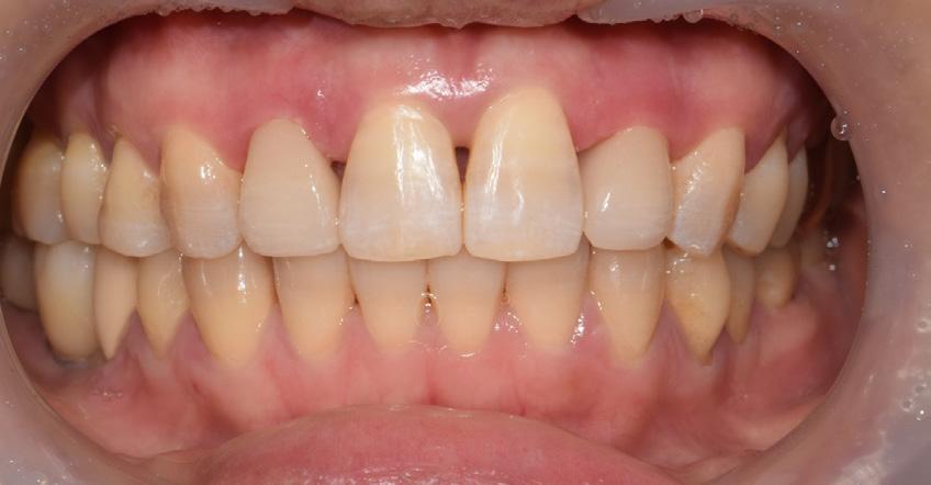 Right after the fixed retainers were bonded between central incisors, PFM crowns on 12