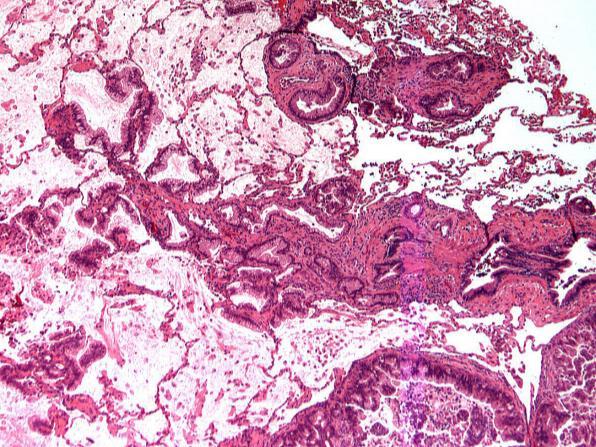WHO Classification Lung Adenocarcinoma 2015 Adenocarcinoma in situ Minimally invasive lesions Subtypes of adenocarcinoma Lepidic Invasive mucinous