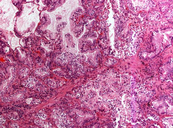 Invasive mucinous adenocarcinoma WHO Classification Lung Adenocarcinoma