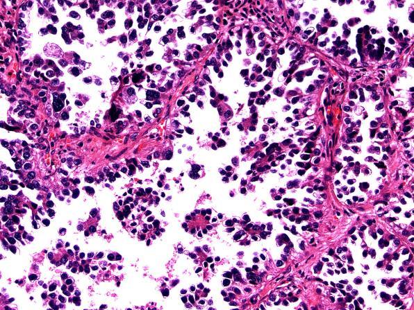 adenocarcinoma Lepidic Invasive mucinous adenocarcinoma Micropapillary