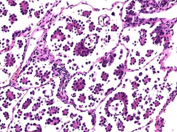 solid nests or single cellls Not measured as part of tumor Reported