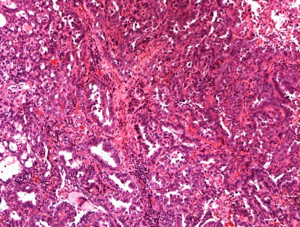 Lepidic Invasive mucinous adenocarcinoma Micropapillary