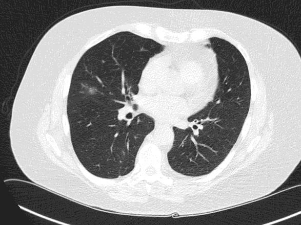 WHO Classification Lung Adenocarcinomas 2015 Adenocarcinoma in situ Minimally invasive adenocarcinoma Lepidic