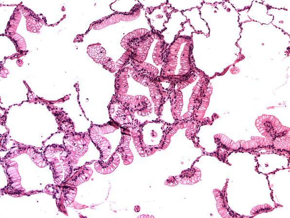 hyperplasia (AAH) Adenocarcinomas: Acinar Papillary