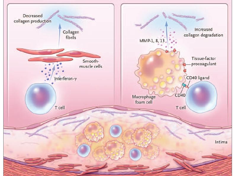 Pathogenesis of Atherosclerosis Atherosclerosis is a DIFFUSE DISEASE driven by inflammation, atherogenic lipoproteins and in