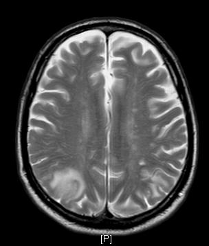70 year old with stroke HTN