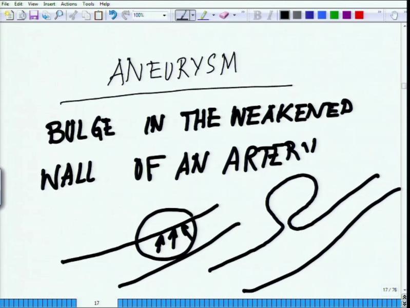 (Refer Slide Time: 25:52) You may hear this or see this somewhere written like this is the word Aneurysm, what exactly is Aneurysm going by the definition of
