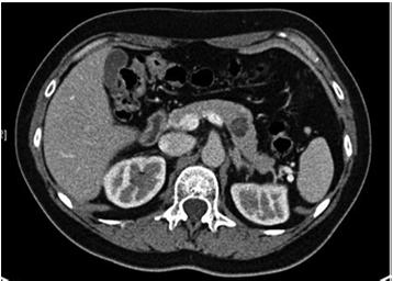 Case Example She follows up with her PCP and a contrast enhanced CT is obtained which describes a 1.6 cm, fluid density, cystic lesion in the body of the pancreas.