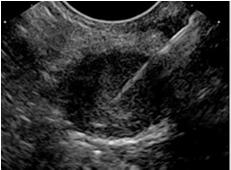 Case Example EUS shows 1.5 cm anechoic lesion, consistent with cyst, thin wall, no associated nodularity, or mass lesion, and a nondilated pancreatic duct.