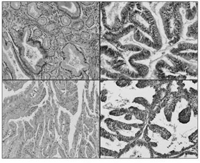 production Histologic subclassification Gastric Intestinal Pancreatobiliary Oncocytic Ohtsuka T