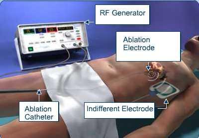 RF Circuit Circuit consists of RF generator, catheter and