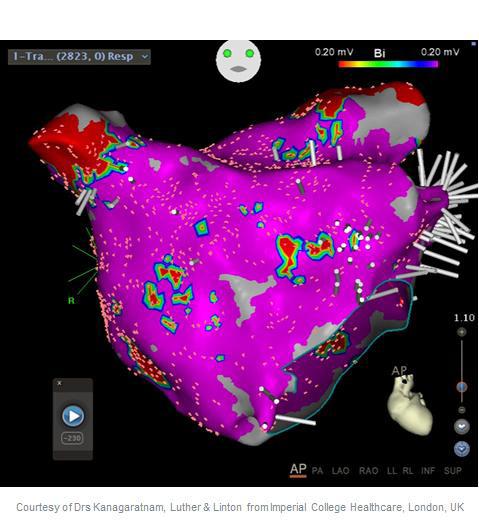 Locate Where to Ablate: Ripple Mapping Ripple Mapping designed to increase efficiency in interpreting arrhythmia mechanisms by: Displaying