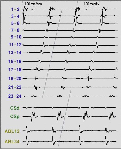 Common Tachyarrhythmias Studied in the EP Lab - Paroxysmal Supraventricular Tachycardia (PSVT) Frequency of 2.