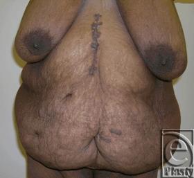 Patient 10 A 45-year-old female patient presented with a large panniculus and associated chronic skin problems in the lower abdomen after massive weight loss (140 lb) following open gastric bypass