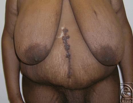 Umbilical Transposition in Functional Panniculectomy of the Massive Weight Loss Patient: Is It Aesthetic Figure 6.