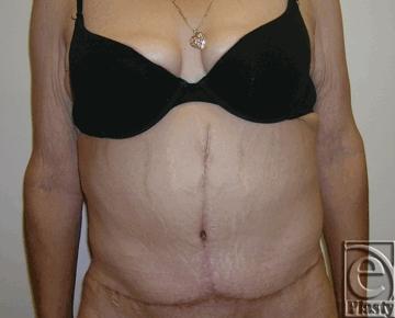 She desired to preserve her navel and thus underwent a functional horizontal panniculectomy, minimal excision of vertical excess skin and subcutaneous fat from the supraumbilical region, and