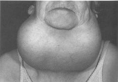 T4 Body makes thyroid bigger to try to make more