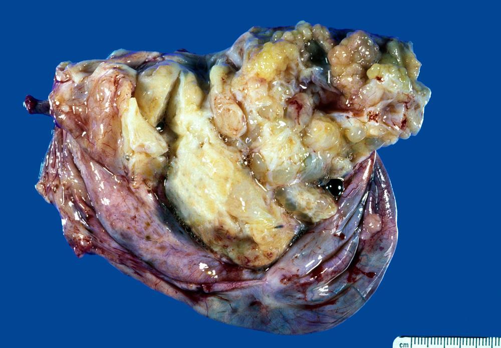 Seromucinous Borderline Tumor, WHO 2014 (Mucinous Tumor of Low Malignant Potential, Endocervical Type) Gross Features Variable size, 2-36 cm Mean, 7