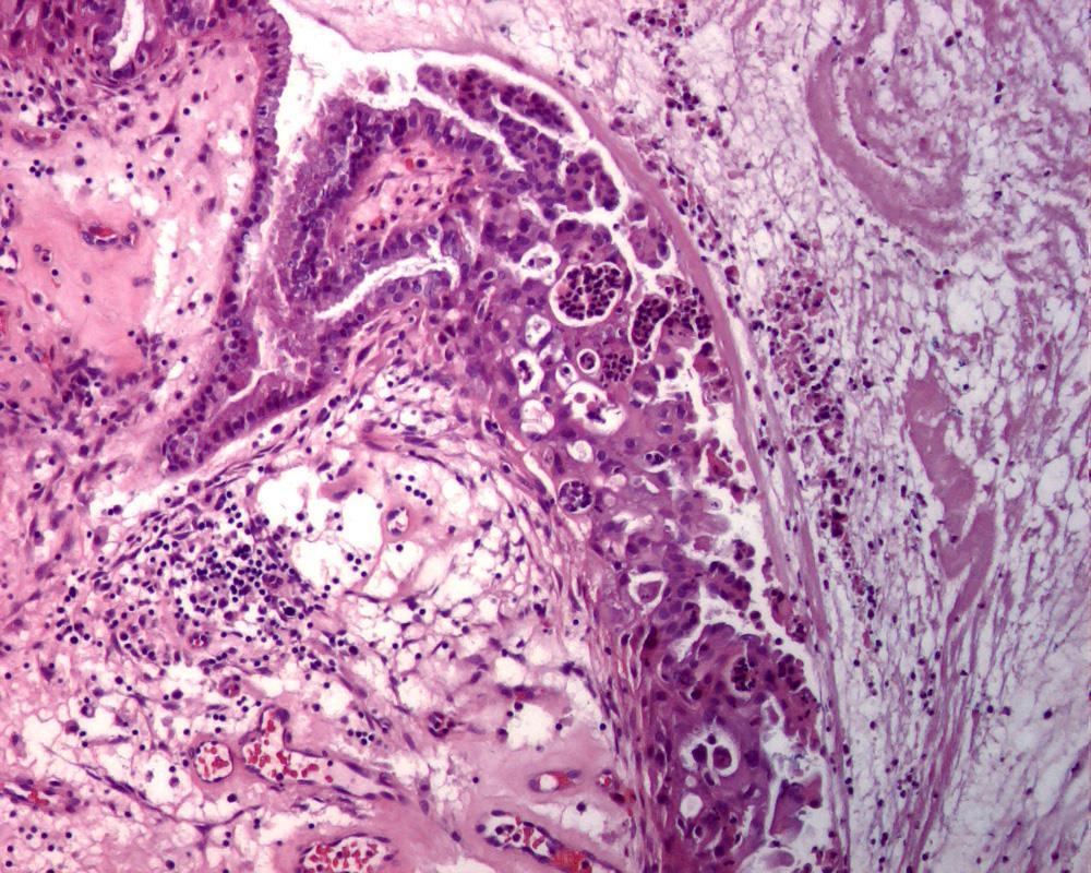 Columnar Cells Mimicking Endocervical