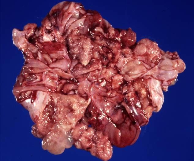 Mucinous Carcinoma Infrequent Usually unilateral Gross Features Usually large and