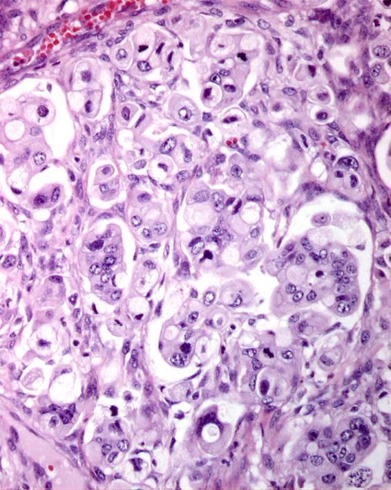 Invasive Mucinous Carcinoma Infiltrative Type Small glands, nests of cells or individual