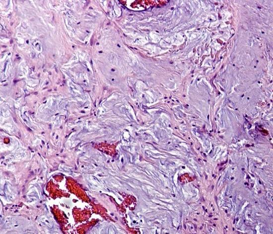 Ovarian mucinous tumors associated with an ovarian teratoma