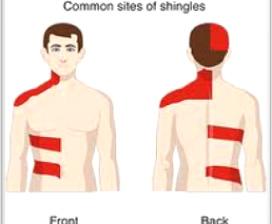 What are the symptoms of shingles? The main symptom of shingles is a rash. The list below may help you determine if your rash is from the herpes zoster virus.