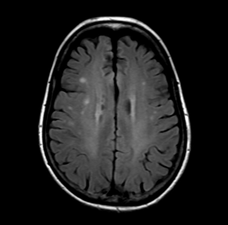 Neuroimaging Brain MRI: Non-specific white matter