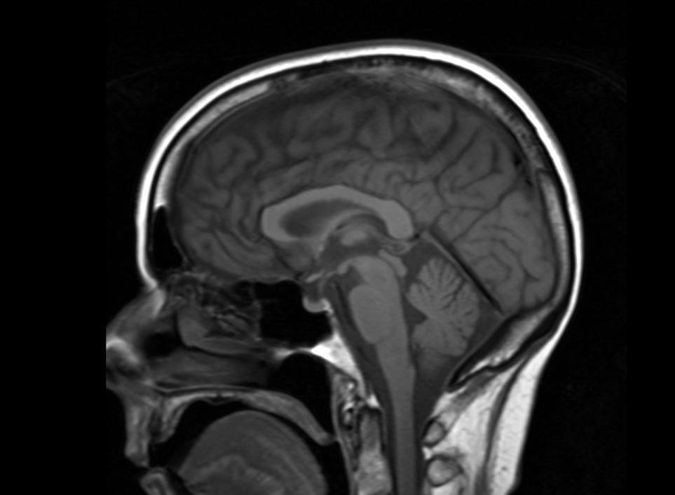Neuroimaging MRI: Sagittal
