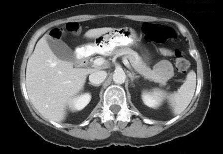 CT of abdomen / pelvis with contrast showing a solid 3.8 x 2.9 x 3.