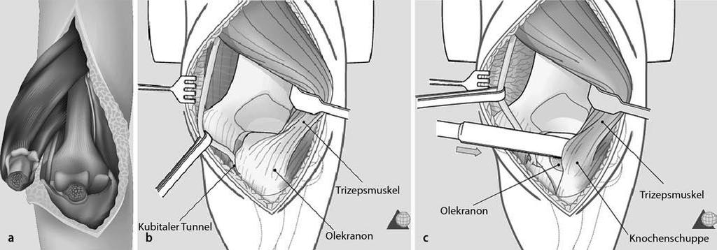 Elbow System Operational approach Identify and protect nervus ulnaris a