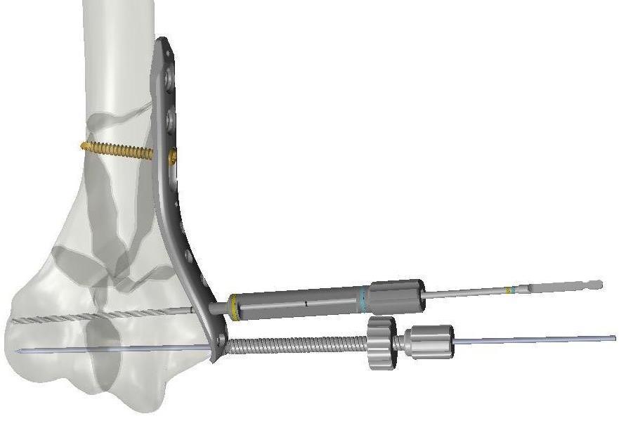 Elbow system / Medial Plate Drill guide is marked with two measurement options 1. 10-42mm (2mm steps) 2.