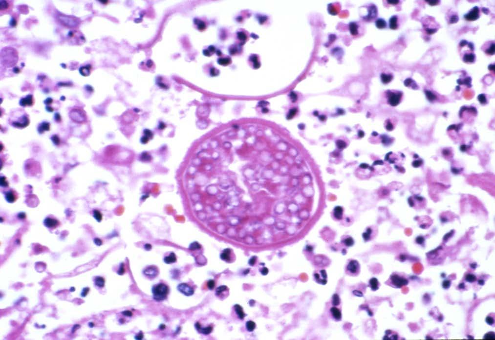 Spherules (Hematoxylin-Eosin