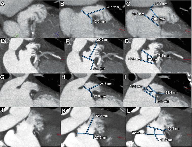 Cardiac CCTA Measurements of LAA Anatomic Variation Shapes Watchman Amplatzer 25 Cauliflower