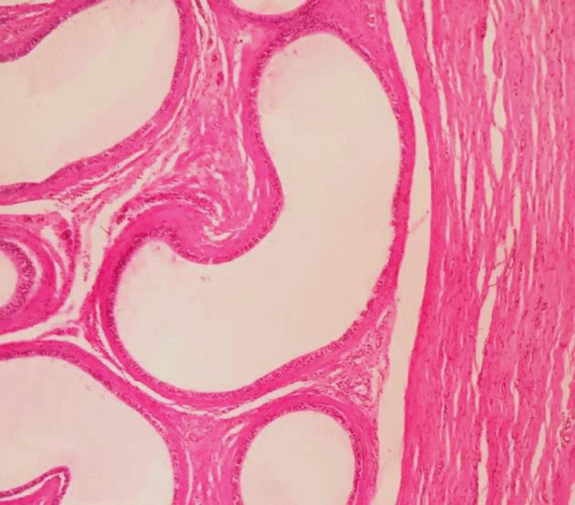 Epididymis (cross section) - severe thickness of tunica serosa, evident interstitial connective tissue proliferation; diffuse ectasia of ductus deferens(chronic severe epididymitis) Figure 12.