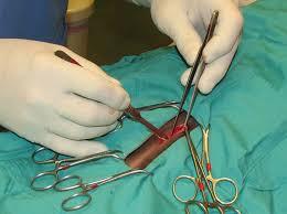 Liver Biopsy l Key hole laparotomy l Obtain a relatively large sample, can be from more than one lobe l Quantitative copper levels l Often a day procedure
