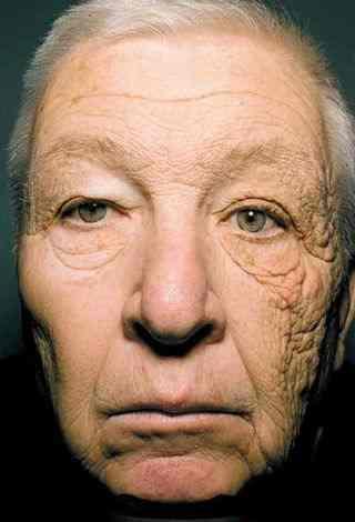 Sun Damage Over Time JAMA June 2012 The 66-year-old truck driver suffers from unilateral dermatoheliosis or photo-aging, which was caused by repeated, long-term exposure to UVA rays of the sun.
