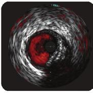 desired, activate ChromaFlo by pressing the ChromaFlo key on the control panel Turn VH IVUS display on or off when VH data is