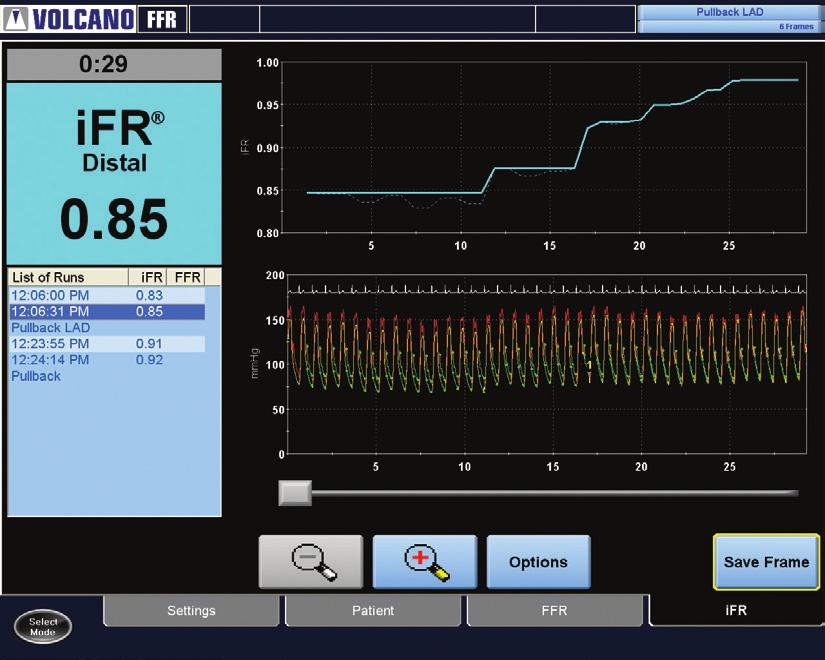 FFR measurement Measure the FFR Value I.C.